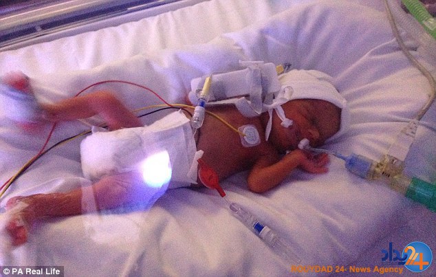 بهبود عجیب نوزادی که دچار اختلال مغزی بود (تصاویر)