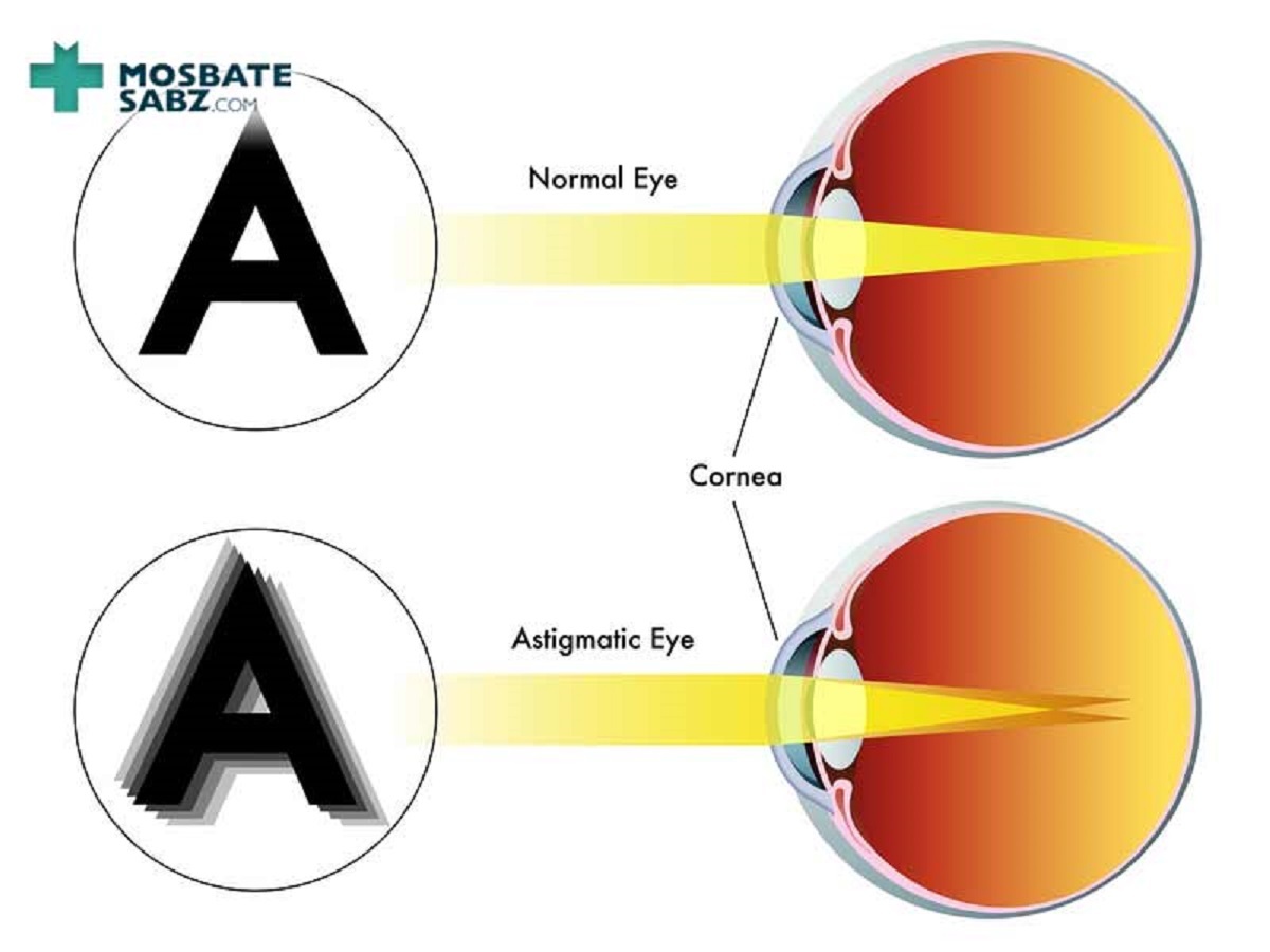آستیگمات چشم چیست؟ +علائم و درمان
