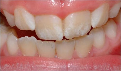 دلیل لکه‌های سفید روی دندان چیست؟