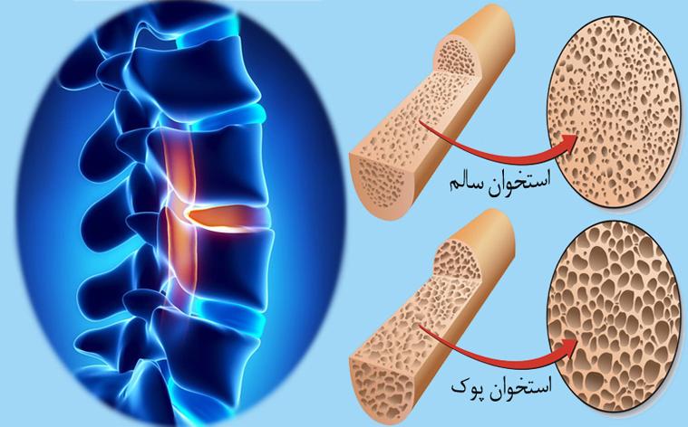 چه کسانی باید تست تراکم استخوان انجام دهند؟