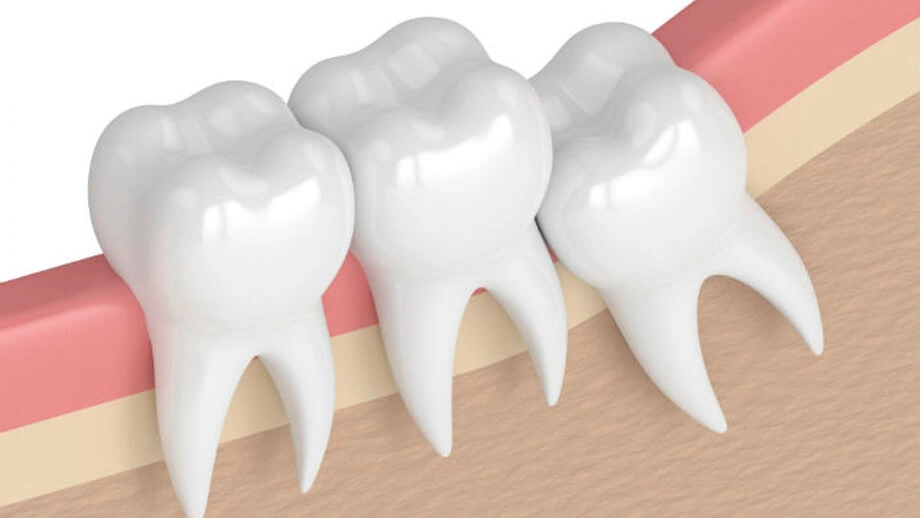 عوارض کشیدن دندان عقل: نکاتی که باید بدانید