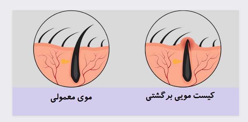 کیست مویی چیست؟