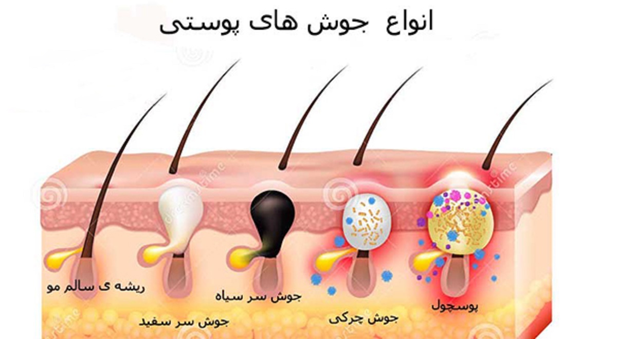 انواع جوش صورت