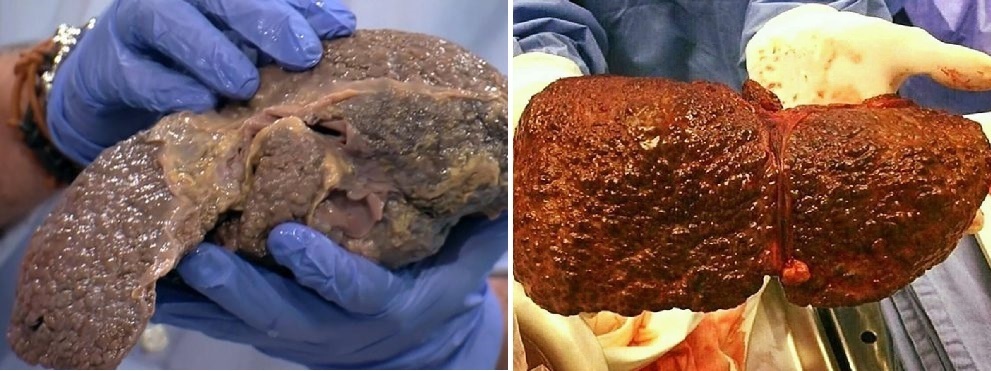 کبد چرب چیست؟ بررسی گریدهای مختلف و علائم هر کدام کبد چرب چیست؟ بررسی گریدهای مختلف و علائم هر کدام