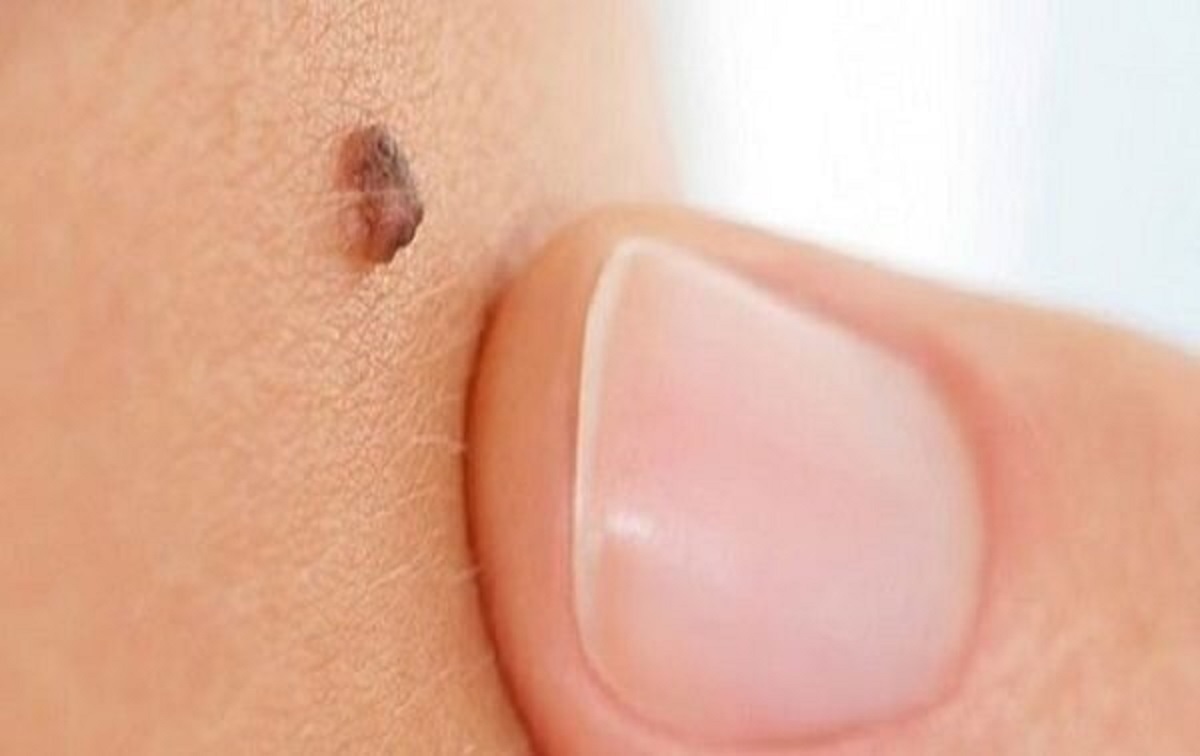 علامت مهم خال سرطانی را بشناسید علامت مهم خال سرطانی را بشناسید